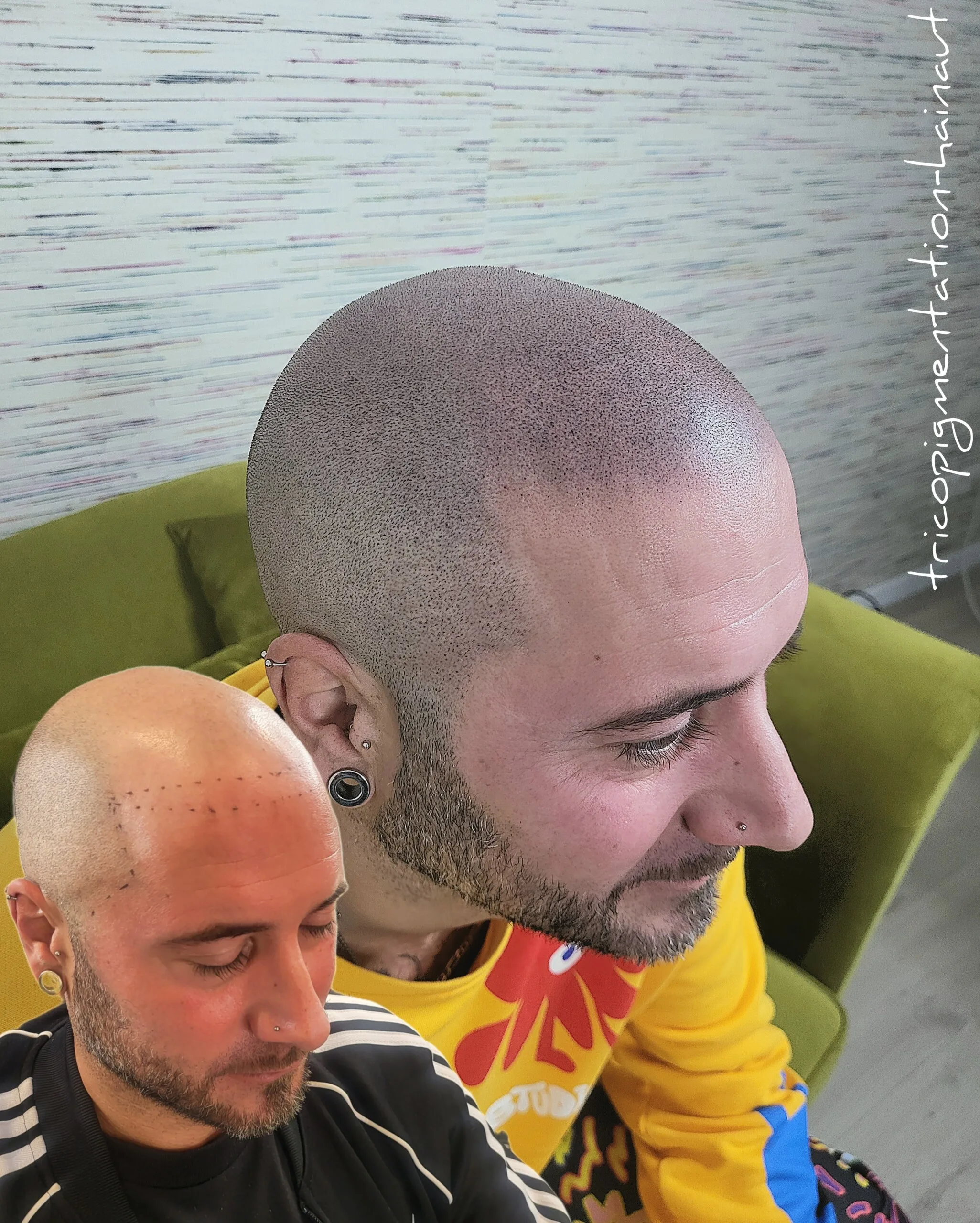 Micropigmentation effet rasé homme hyper-réaliste — calvitie avancée, résultat naturel impeccable