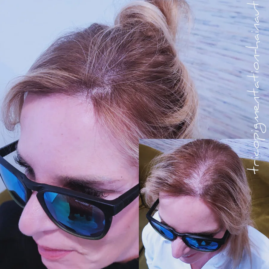 Avant après solution alopécie femme effet densité micropigmentation