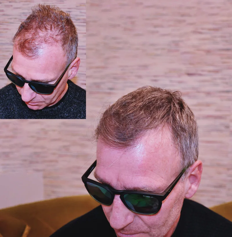 Avant après traitement calvitie homme par micropigmentation capillaire