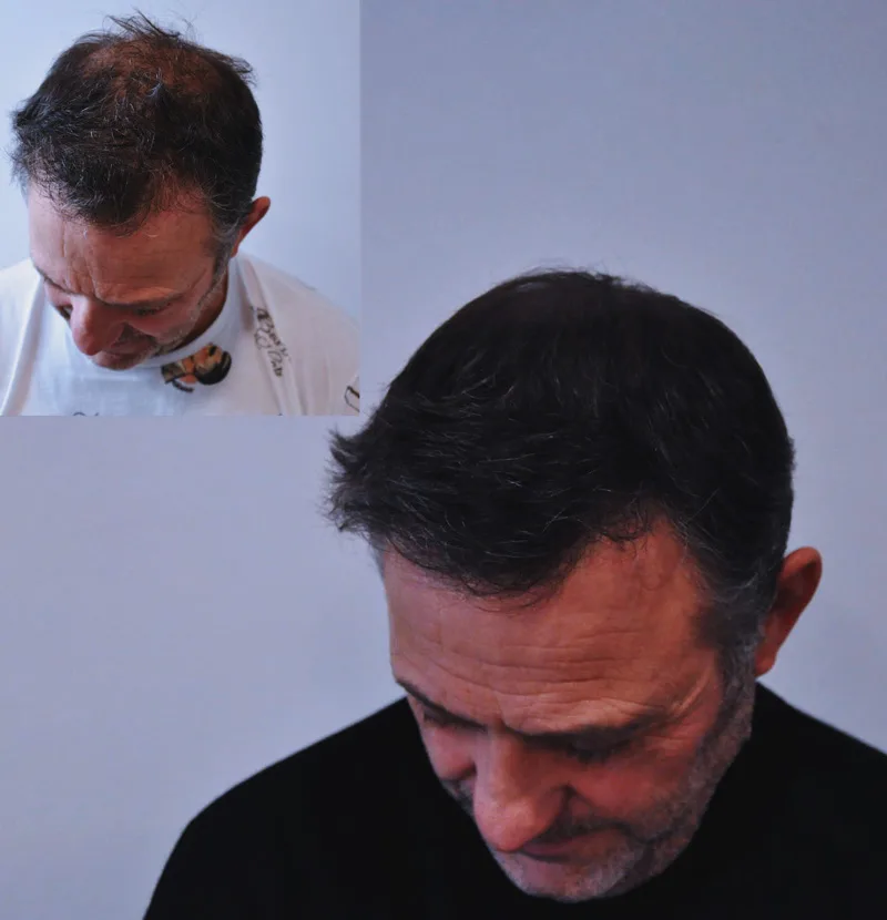 Avant après micropigmentation effet densité homme — cheveux clairsemés densifiés, résultat naturel