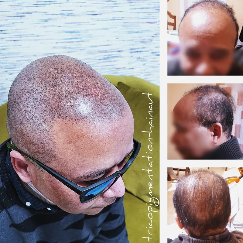Avant après micropigmentation effet densité homme — densification capillaire cheveux fins