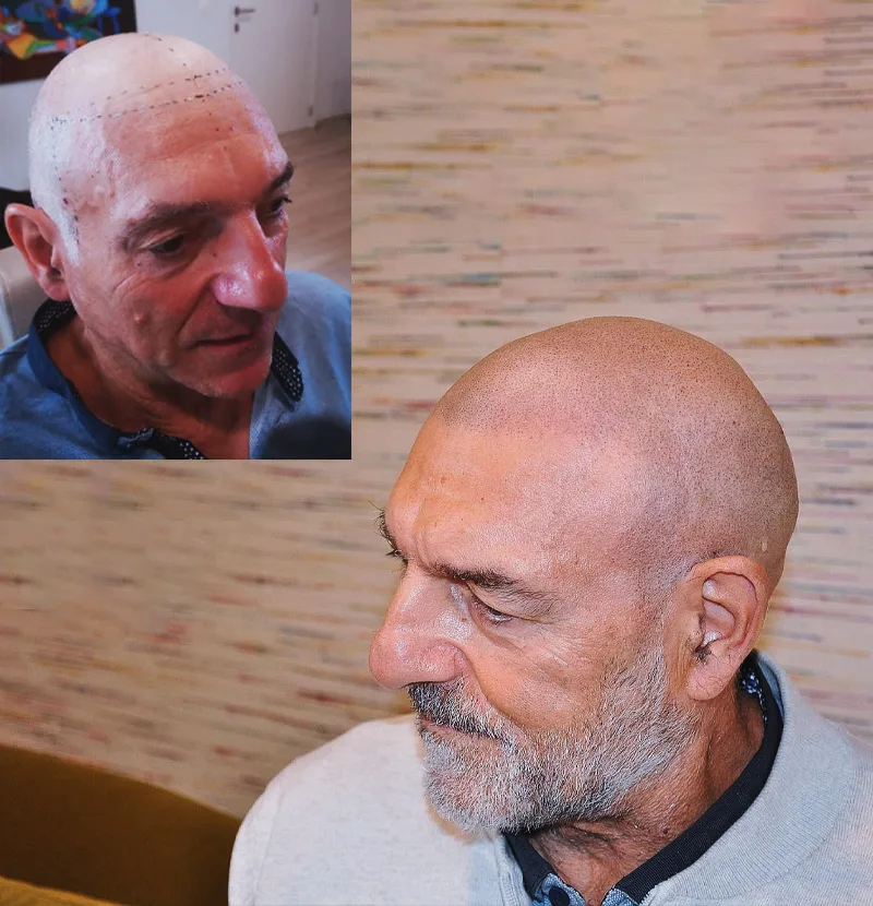 Avant après micropigmentation effet rasé homme — traitement calvitie couronne, pigments organiques
