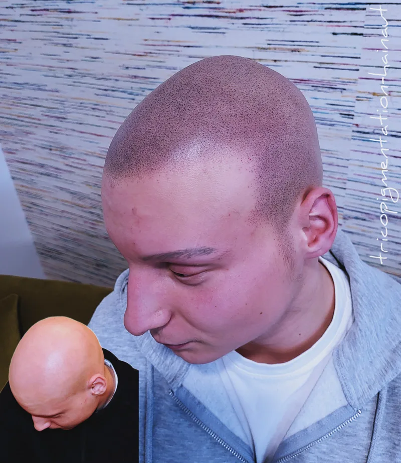 Micropigmentation effet rasé réaliste — traitement calvitie temporale, pigments naturels carbone