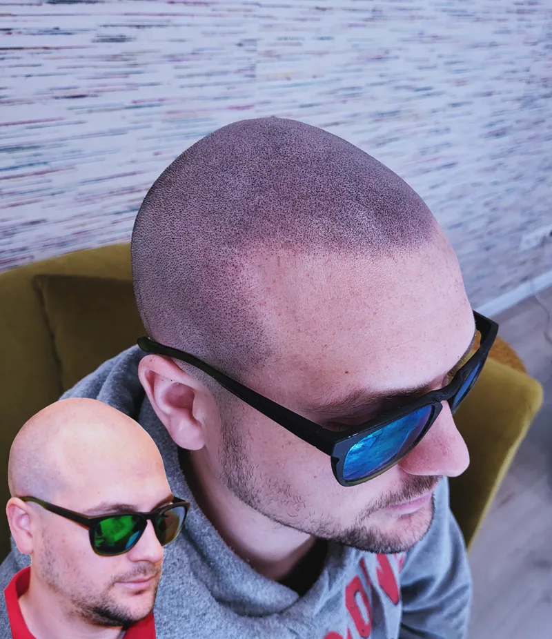 Résultat micropigmentation calvitie totale — effet rasé hyper-réaliste homme, Namur
