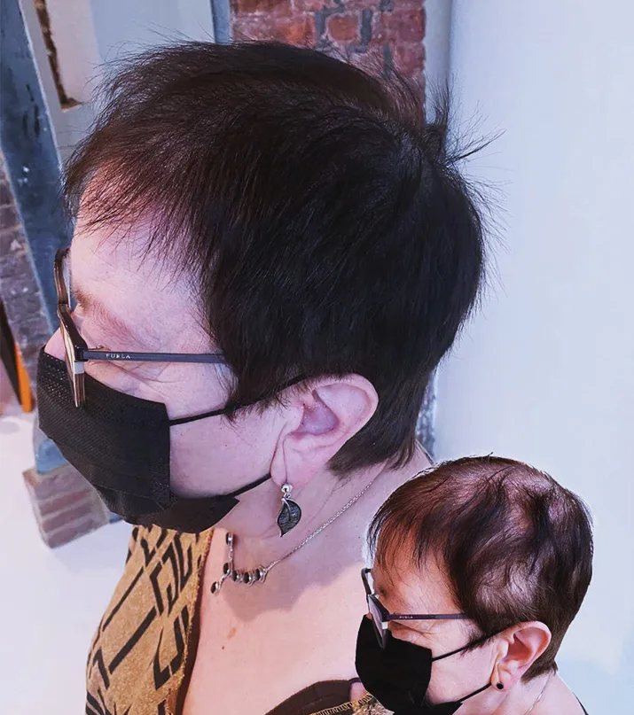 Avant après micropigmentation densité femme — solution alopécie et perte de cheveux clairsemés