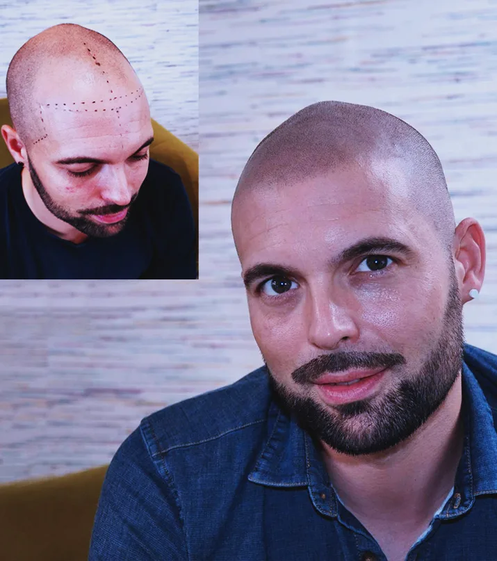 Avant après effet rasé micropigmentation homme — calvitie frontale et couronne traitée