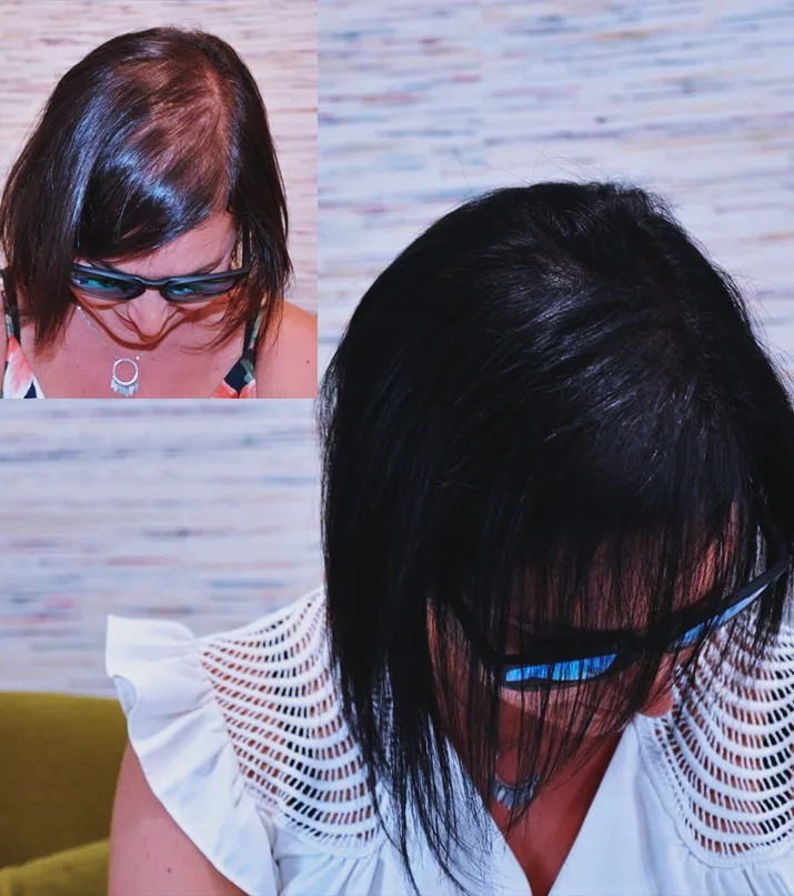 Avant après micropigmentation effet densité femme — alopécie féminine traitée, cheveux clairsemés