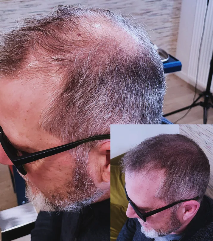 Résultat dermopigmentation capillaire — traitement calvitie micropigmentation Namur Belgique
